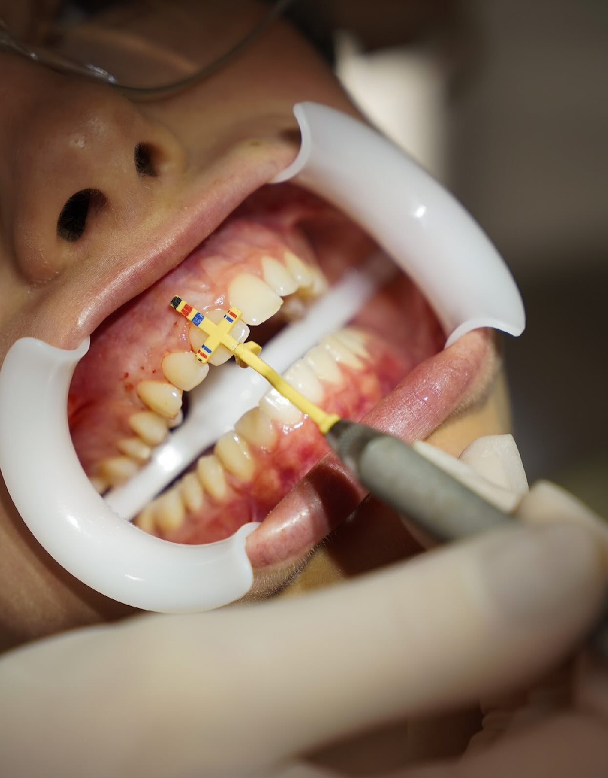 Instrumento milimetrado posicionado sobre os dentes anteriores durante o planejamento da gengivoplastia